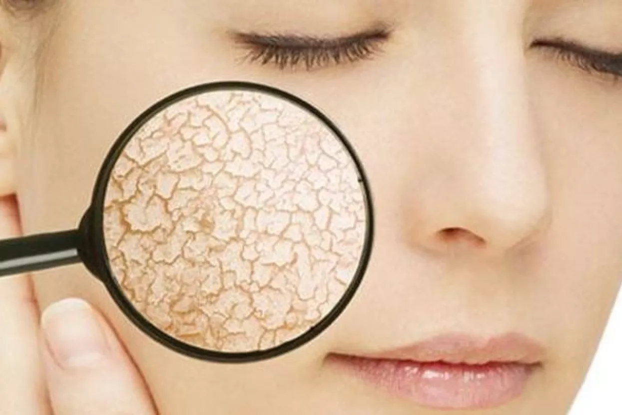 Vitaminske kreme: Izbjegnite efekt sasu&scaron;ene marelice