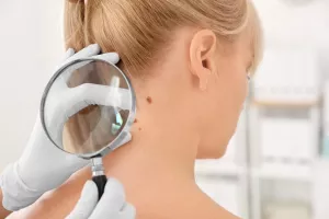 Stres i koža: Akne su još najmanji problem